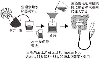 IBD（炎症性腸疾患）患者への便微生物移植の方法