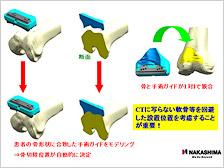 手術ガイドの設計