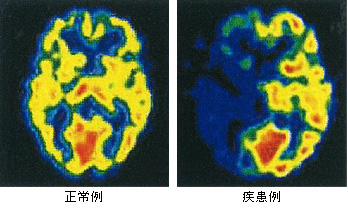 脳血液シンチグラム（SPECT診断薬）