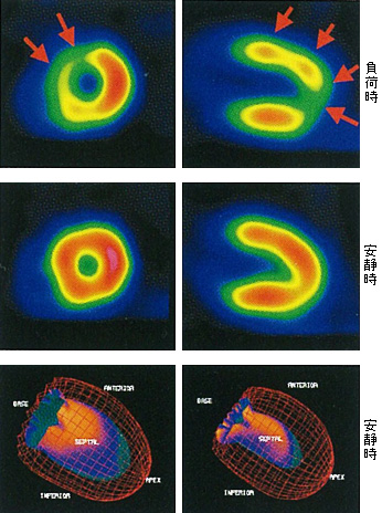 心臓シンチグラム（SPECT診断薬）