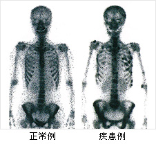 骨シンチグラム（SPECT診断薬）