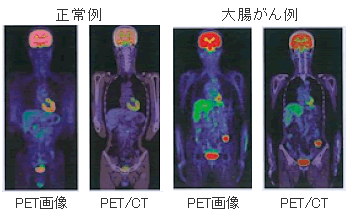 PET画像とPET/CT画像
